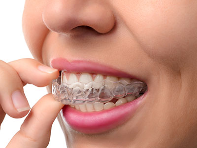 Emerson Invisalign