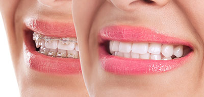 Emerson Dental Braces