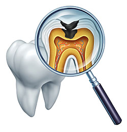 Emerson Tooth Decay