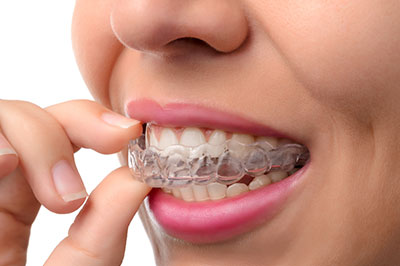 Invisalign Dentist 77318