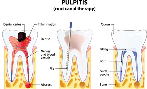 Emerson Root Canal Treatment