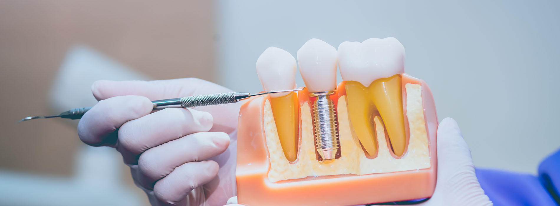 Dental Implants in Emerson