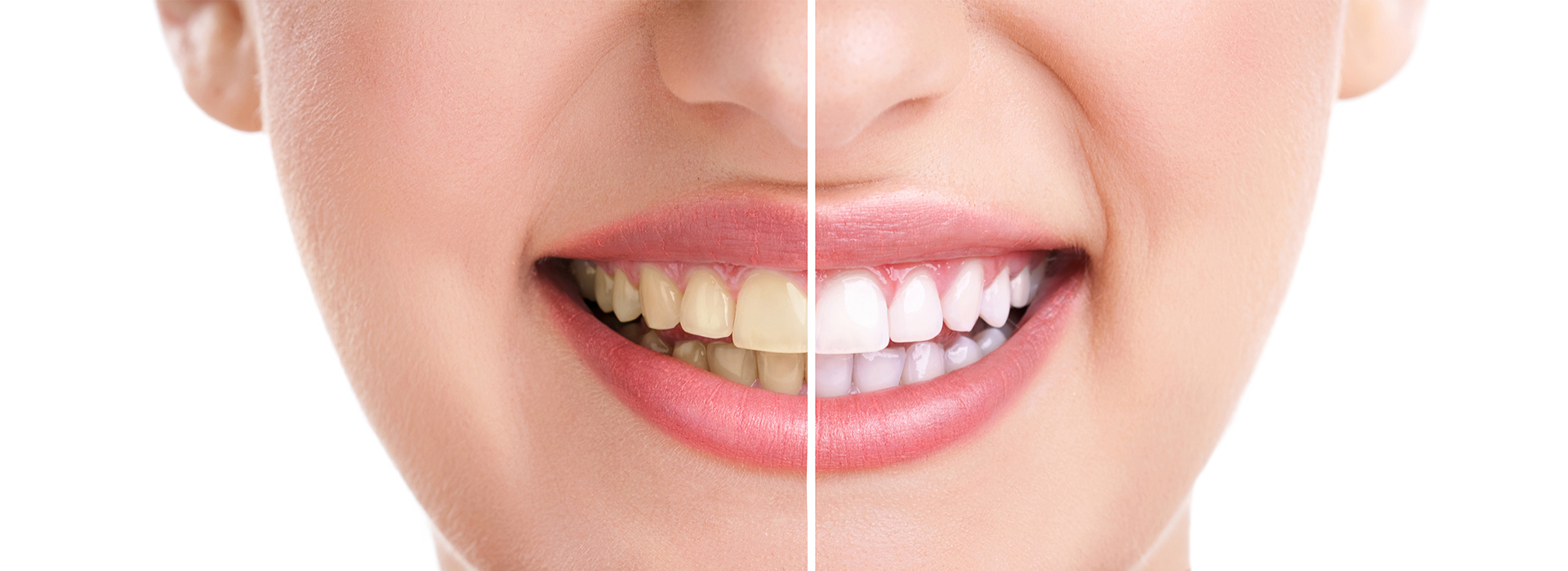 Teeth Whitening Dentist near Emerson